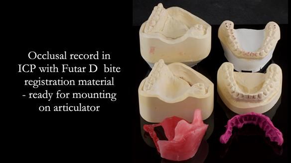 Upper metal base partial denture/occlusal stabilisation splint/obturator - full protocol
