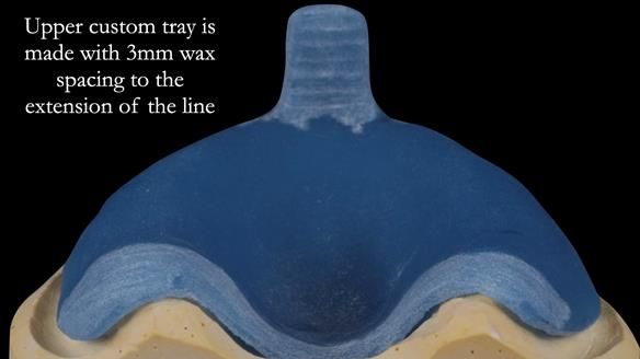 Newsletter 53 showing the making and fitting of ultra life-like dentures for Valena