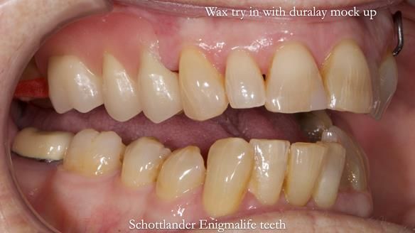 Finlay's Newsletter 60 Sylvia's upper Kennedy Class 2 Mod 1 metal based upper RPD