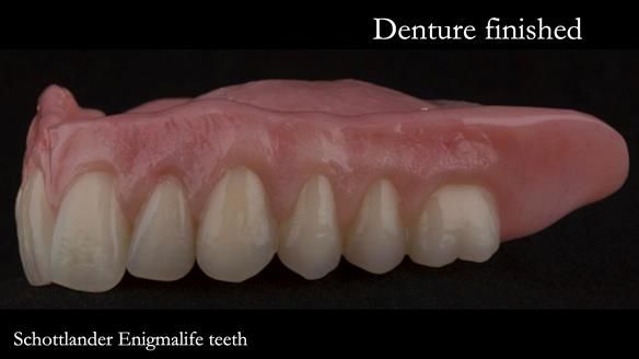 Newsletter 75: Marion’s case - Step-by-step complete denture workflow