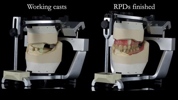 Newsletter 55 Provision of metal based partial dentures for Zephyrine with a repaired cleft lip and palate