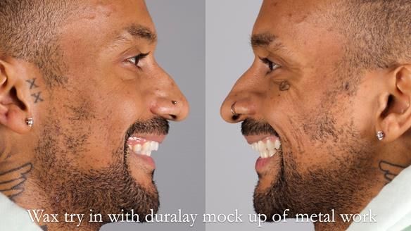 Upper metal base partial denture/occlusal stabilisation splint/obturator - full protocol