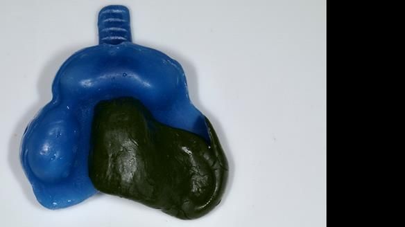 Newsletter 86 Peter the Architect — precision removable partial dentures case study