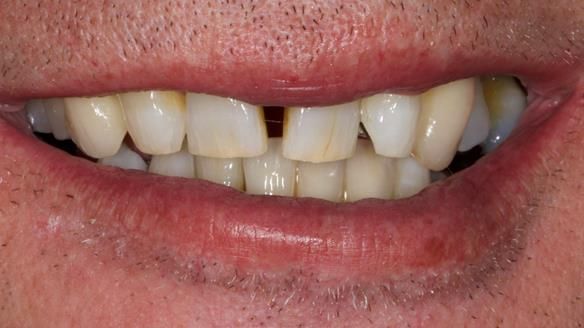 Newsletter 86 Peter the Architect — precision removable partial dentures case study