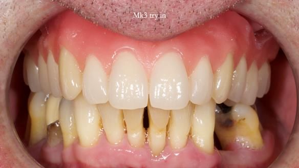 Newsletter 77: Jeremy’s case – immediate complete upper denture