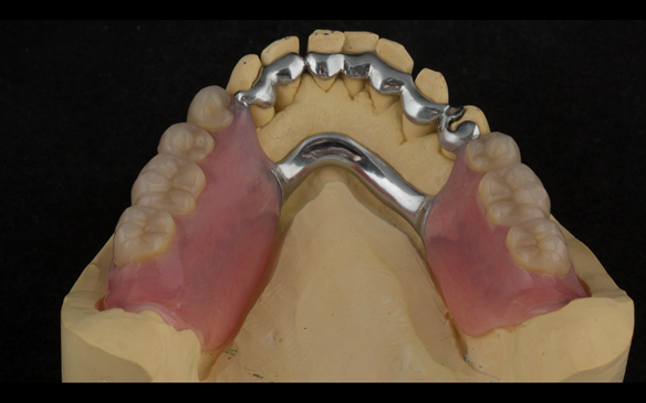 Figure 112 Mk 2 mandibular metal based denture showing open Scandinavian hygienic design.