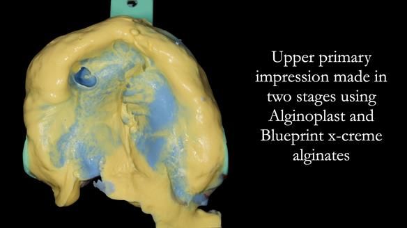 Newsletter 55 Provision of metal based partial dentures for Zephyrine with a repaired cleft lip and palate