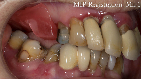 Figure 21 Registration visit with wax rim - teeth in maximum intercuspation