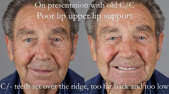 Newsletter 50 Special edition Complete Dentures FULL PROTOCOL