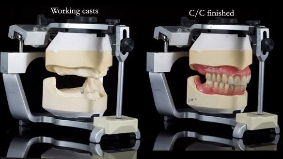 Newsletter 78: What do Clark Gable and a Locator® overdenture have in common?