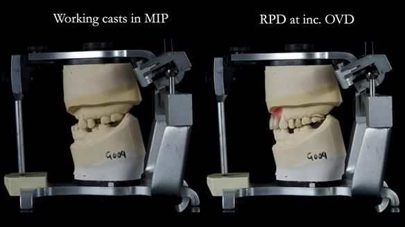 Newsletter 81 - Pam’s Story — how a partial denture changed her life (+ live walkthrough this Thursday)