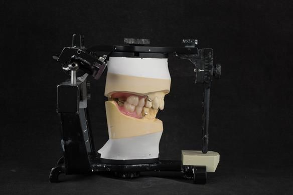 Figure 21 Over impression in alginate to record the teeth using over tray