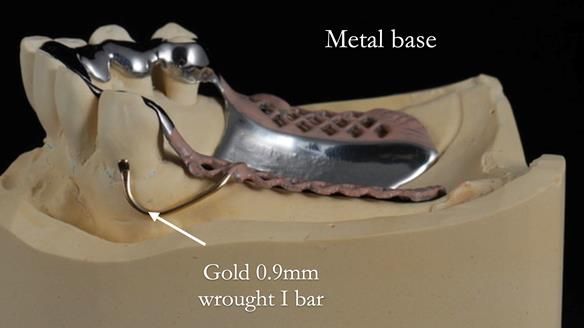 Newsletter 56 showing the making and fitting of a bilateral free end saddle upper removable partial denture (RPD) for patient with pemphigus