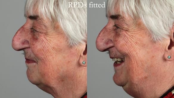 Newsletter 55 Provision of metal based partial dentures for Zephyrine with a repaired cleft lip and palate