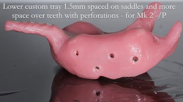 Newsletter 54 case presentation upper complete denture and lower Scandinavian designed hygienic partial denture for David