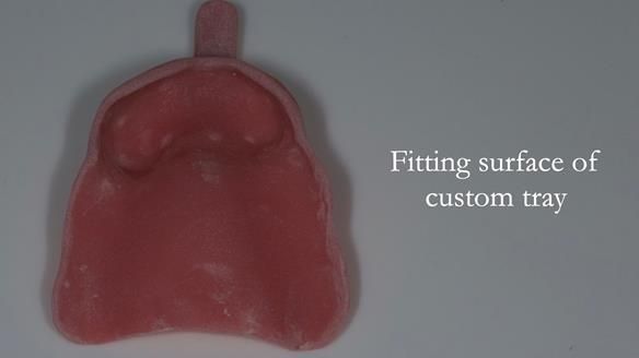 Finlay's Case Study Newsletter 40 - Immediate Mk 1 RPD to Definitive Mk 2 RPD - full protocol