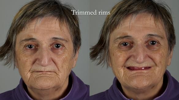 Newsletter 83: Sheila’s Complete Denture Success