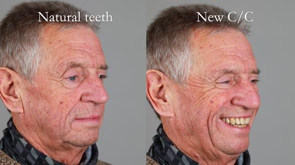 Newsletter 54 case presentation upper complete denture and lower Scandinavian designed hygienic partial denture for David