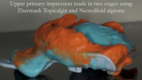 Complete denture Class II div 2 deep overbite Newsletter 39