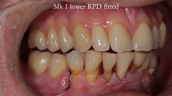 Newsletter 54 case presentation upper complete denture and lower Scandinavian designed hygienic partial denture for David