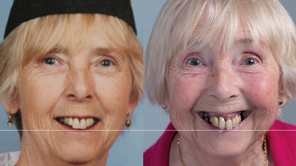 Figure 26 Planning the incisal plane of the immediate denture - lifting the occlusal plane. The patient wanted something similar to the dentate photograph supplied - "but finer"