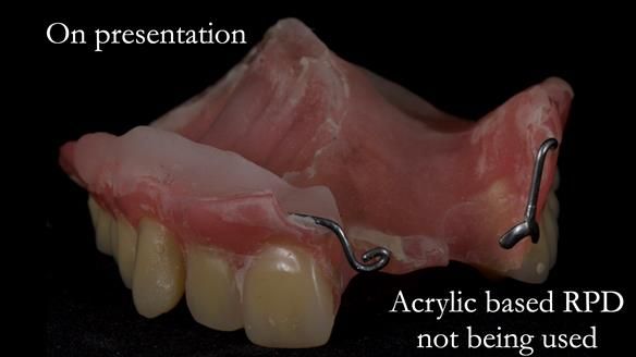 Newsletter 55 Provision of metal based partial dentures for Zephyrine with a repaired cleft lip and palate