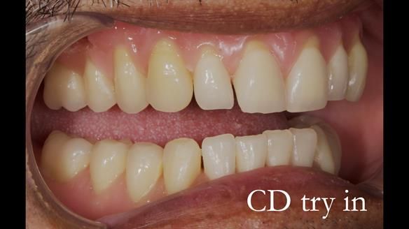 Finlay's Newsletter 62 provision of extractions and metal based complete dentures for Rafique