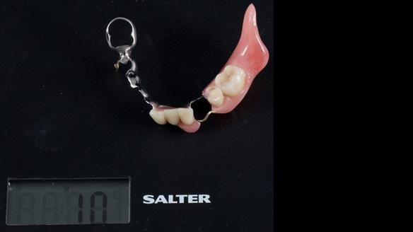 Newsletter 86 Peter the Architect — precision removable partial dentures case study
