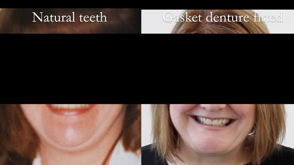 Finlay's Newsletter 58 Gasket upper partial denture for Zoe