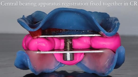 Newsletter 57 showcases the making and fitting process of implant-supported complete dentures for Alisdair