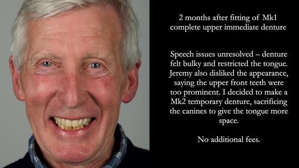 Newsletter 77: Jeremy’s case – immediate complete upper denture