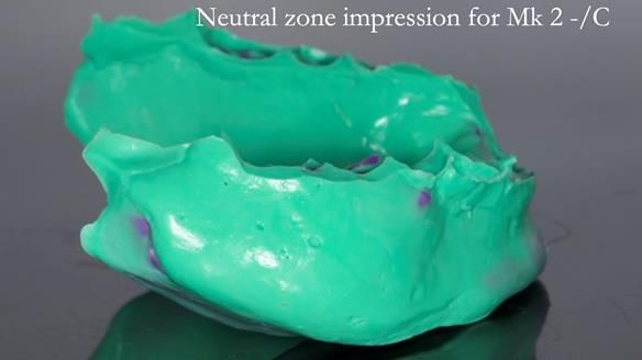Replacing Madeline’s Complete denture FULL PROTOCOL