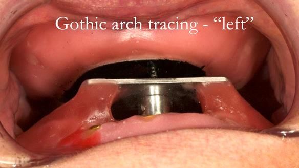 Sequence of use - patient is instructed to move lower jaw the left