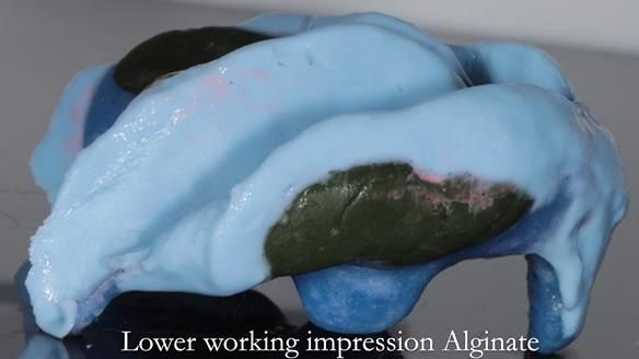 Newsletter 53 showing the making and fitting of ultra life-like dentures for Valena