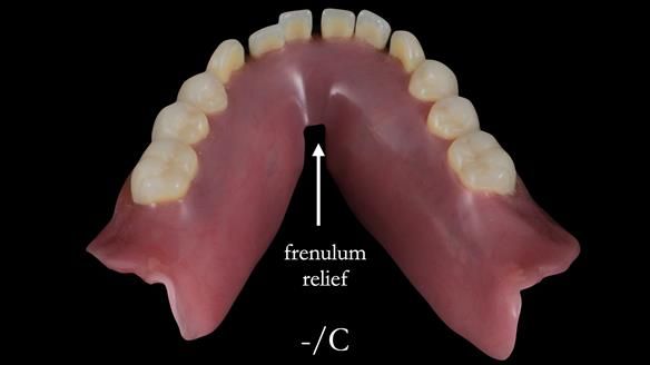 Newsletter 53 showing the making and fitting of ultra life-like dentures for Valena
