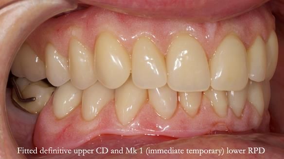 Newsletter 82 Mary - A complete upper and a one-tooth gasket denture