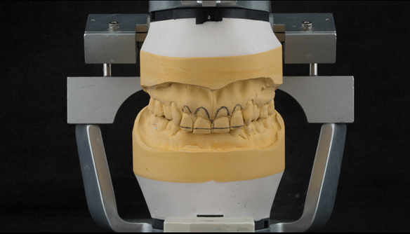 Figure 18 Mounted working cast for Mk 1 immediate denture. Lines drawn on the cast for ideal replacement tooth positions.