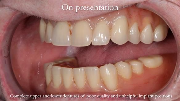 Newsletter 65 Marisa Provision of Complete Dentures on badly placed implants