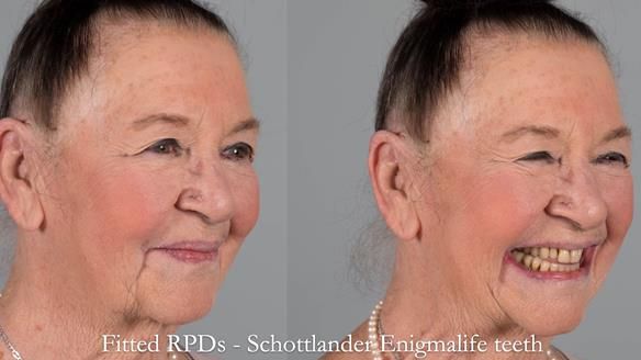 Finlay's Case Study Newsletter 40 - Immediate Mk 1 RPD to Definitive Mk 2 RPD - full protocol