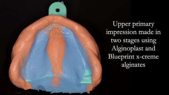 Newsletter 80 - Gordon’s dentures: the one case in 1,000 where my technique failed