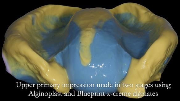 Newsletter 53 showing the making and fitting of ultra life-like dentures for Valena