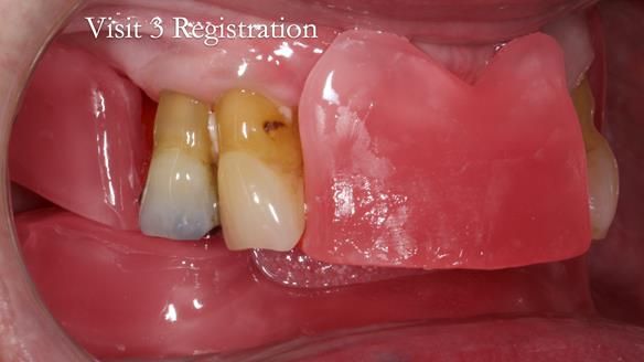 Finlay's Newsletter 59 Ultra hard partial dentures made for Gill
