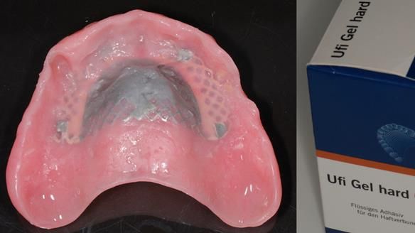 Finlay's Newsletter 62 provision of extractions and metal based complete dentures for Rafique