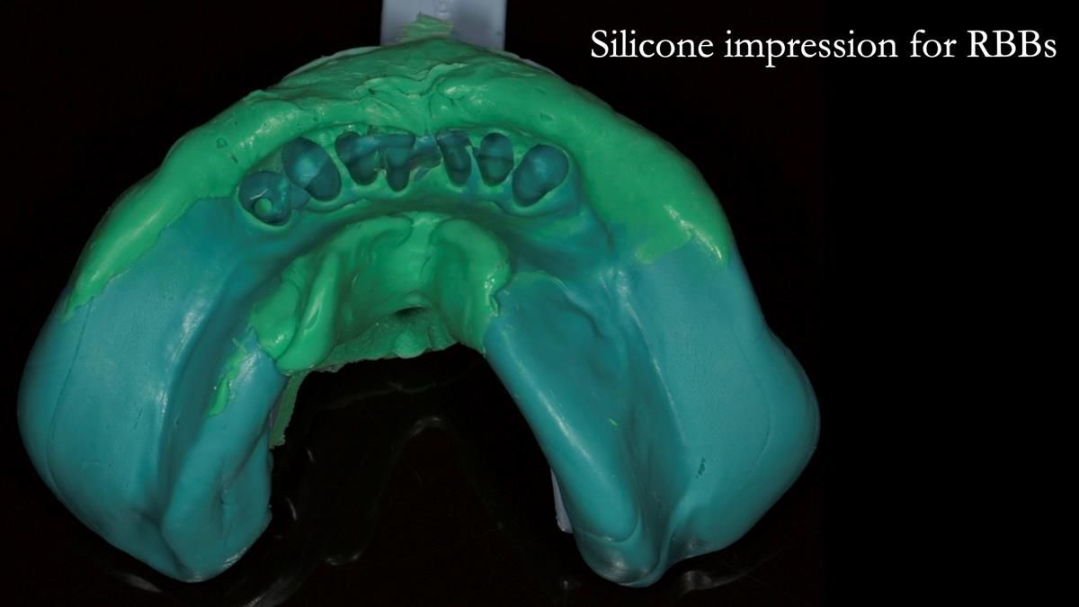 Newsletter 87 – Father Peter: A Partial Denture that needed Minor Miracle