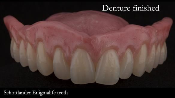 Newsletter 75: Marion’s case - Step-by-step complete denture workflow