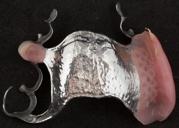 Figure 79 Finished definitive partial denture intaglio surface. Scandinavian design - keeping the denture components 3mm away from the gingival margin