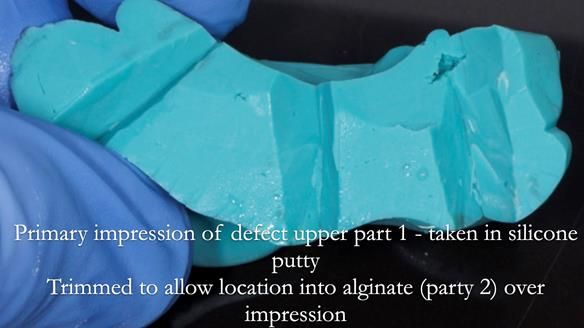 Upper metal base partial denture/occlusal stabilisation splint/obturator - full protocol