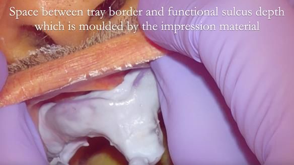 Finlay's Newsletter 62 provision of extractions and metal based complete dentures for Rafique