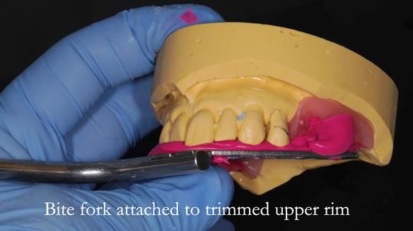 Newsletter 56 showing the making and fitting of a bilateral free end saddle upper removable partial denture (RPD) for patient with pemphigus
