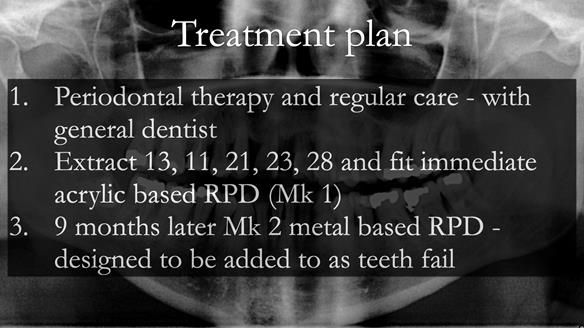Finlay's Newsletter 63 Case study provision of metal based Scandinavian RPD - functional 10 years on